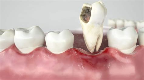 A Comprehensive Look at the Process of Tooth Removal