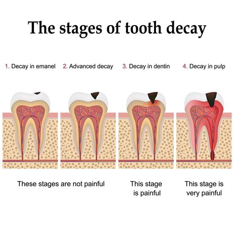 Addressing the Emotional Impact of Dreams about Decayed Teeth: Practical Steps to Find Relief