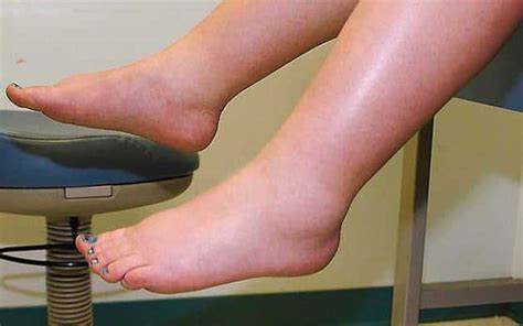 Analyzing the role of poor blood circulation in dream-induced foot swelling