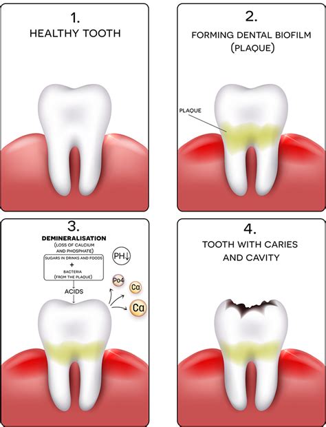 Anxiety and Stress: Unveiling the Triggers behind Nightmares of Dental Cavities