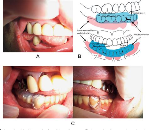 Caring for and Managing Swelling of the Tongue