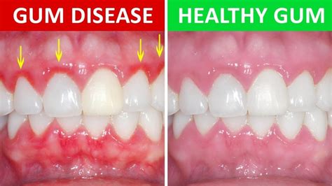 Common Causes of Gum Infection