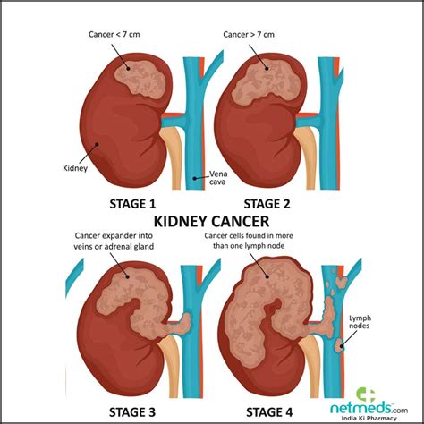 Common Themes and Patterns in Dreams about Cancer of the Kidney: Implications and Insights