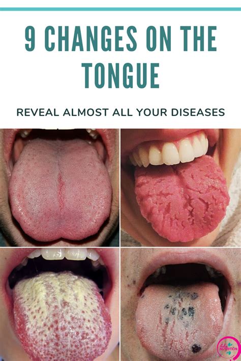 Common Underlying Medical Conditions Associated with Tongue Inflammation