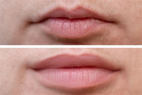 Considering Lip Fillers: Weighing the Pros and Cons