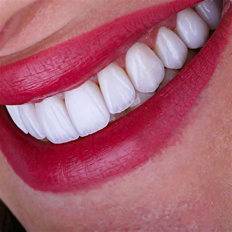 Cosmetic Dentistry: Transforming Your Smile with Porcelain Veneers