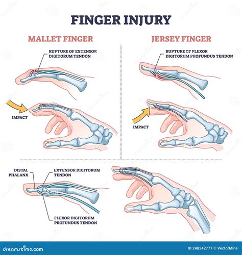 Cultural Diversity in Interpreting Dreams of Hand Injuries