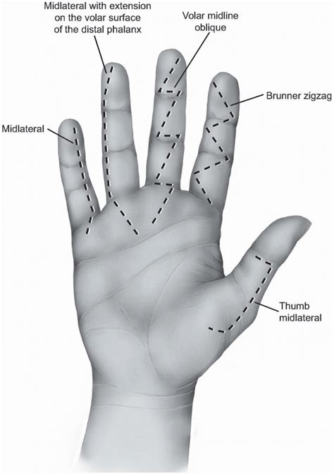 Deciphering Various Types of Hand Incisions in Dreams