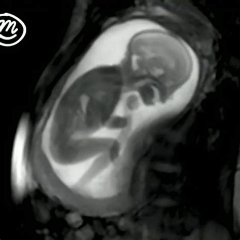 Decoding Baby Scans: A Glimpse into Your Unborn Child's World