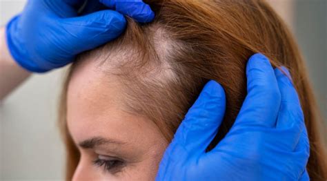 Decoding the Enigma: Unraveling the Mystery Behind Hair Loss in Dreams