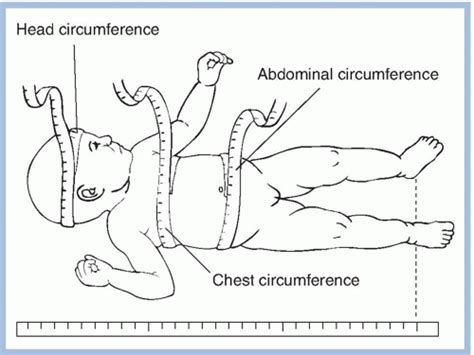 Decoding the Significance of an Infant Limb Emanating from the Abdomen