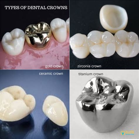 Different Types of Dental Crowns: Choosing the Perfect Fit for Your Smile