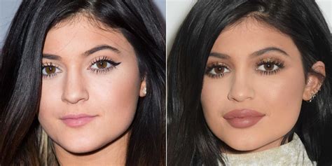 Discover the World of Lip Enhancements: What You Should Know