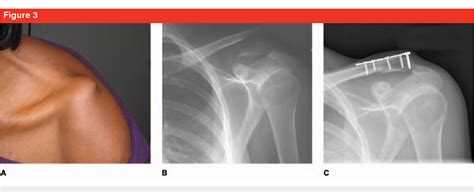 Dreaming of Fractured Clavicles: What Does it Signify?