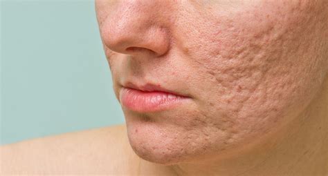 Effective Approaches to Banish Severe Pimples: Professional Insights