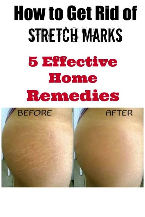 Enhancing Blood Circulation and Reducing Stretch Marks through Invigorating Massage Techniques