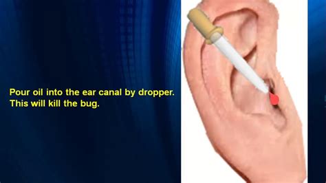 Exploring Effective Solutions for Dealing with Intrusive Insects in the Ear