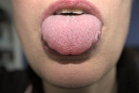 Exploring the Connection between Stress and a Swollen Tongue