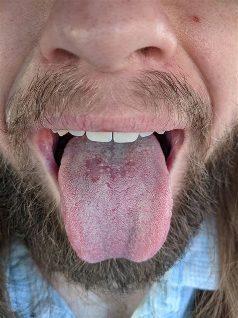 Exploring the Impact of Lifestyle Factors on the Development of Dark Patches on the Tongue