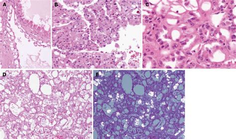 Exploring the Psychological Significance of Themes in Dreams Associated with Renal Cell Carcinoma