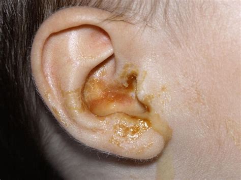 Exploring the Reasons Behind Enormous Ear Secretions