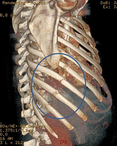 Exploring the Relationship Between Symbolic Rib Injuries and Emotional Trauma