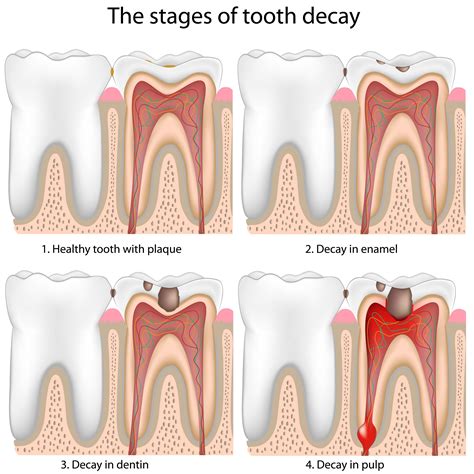 Exploring the Significance of Empty Dental Cavities in Relation to Self-Perception