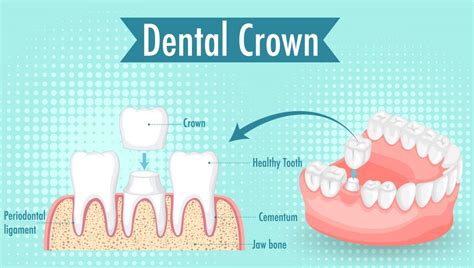 Factors to Consider when Determining the Cost of Dental Crowns