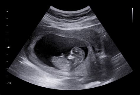 From Science to Heartstrings: How Baby Ultrasounds Touch Our Souls