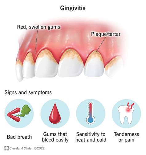 Gum Disease: Signs and Symptoms