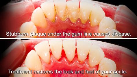 Gum Disease Treatments: Scaling and Root Planing