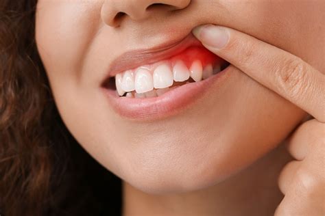 Gum Infection: What You Should Be Aware Of