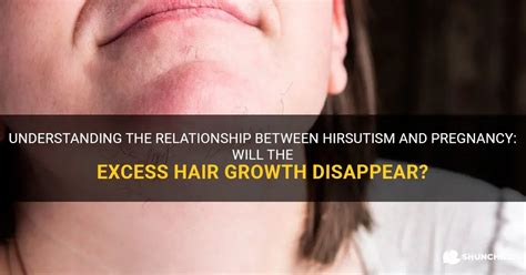 Hirsutism: Understanding the Medical Condition Associated with Excessive Hair Growth