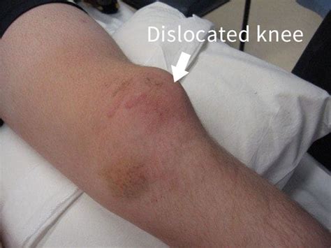 Identifying the Symptoms of a Dislocated Knee: Pain, Swelling, and Restricted Range of Motion