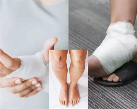 Insights and Techniques for Analyzing and Engaging with Dreams Involving a Wound on the Foot