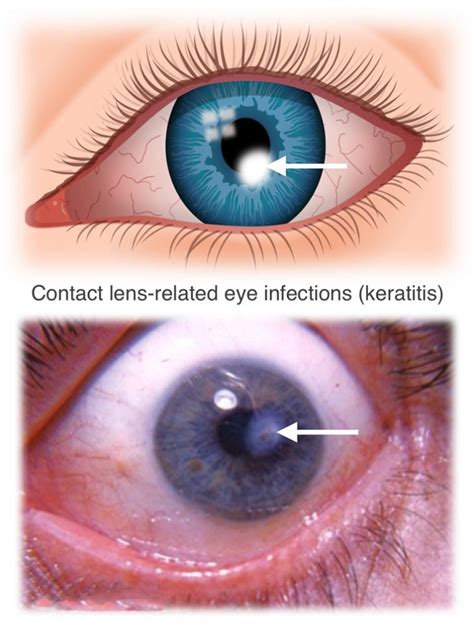 Investigating the Possible Causes and Triggers for Dreams Related to Eye Infections