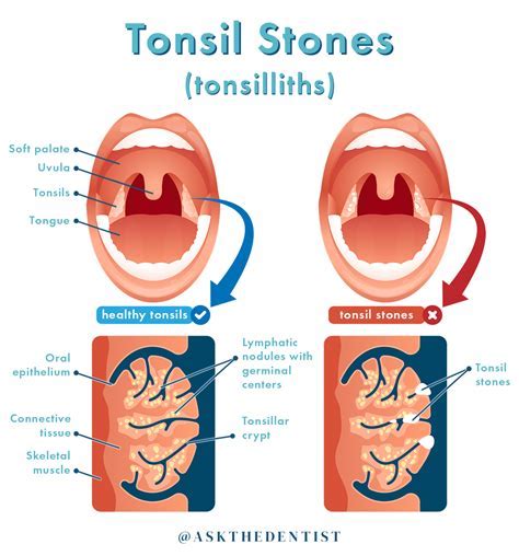 Is the Presence of Tonsil Stones Dangerous? Dispelling the Fallacies