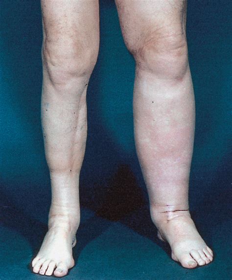 Medical Interventions: Treatment Options for Swollen Lower Limbs