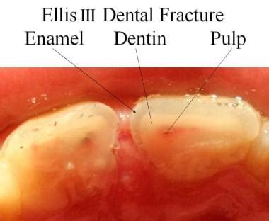 Overview of Denture Fractures: Understanding the Issue