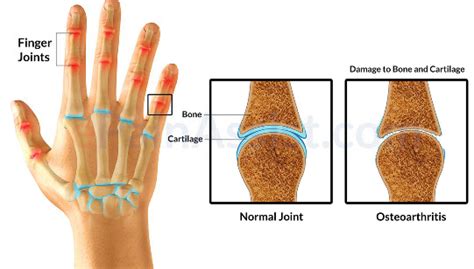 Possible Reasons for Dreaming About Finger Injuries