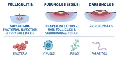 Potential Factors that Contribute to the Development of Boils on the Facial Area