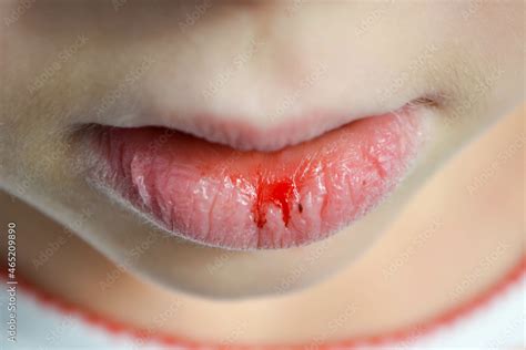 Practical Recommendations for Reoccurring Lip Hemorrhage Nightmares