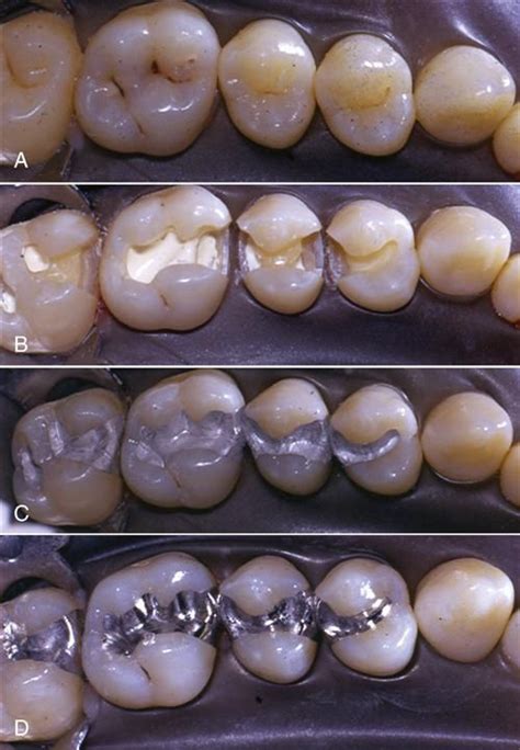 Prepping the Surface: Steps for a Smooth and Effective Restoration