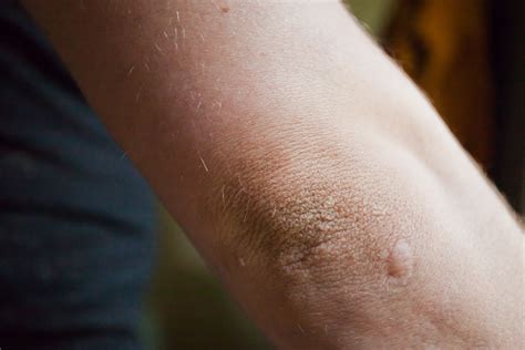 Preventing Dirty Elbows: Tips for maintaining clean and healthy skin