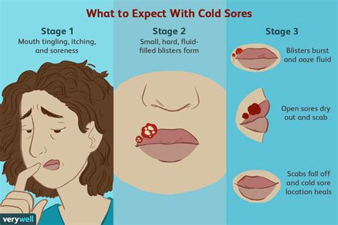 Preventive Measures for Oral Cold Sore Outbreaks