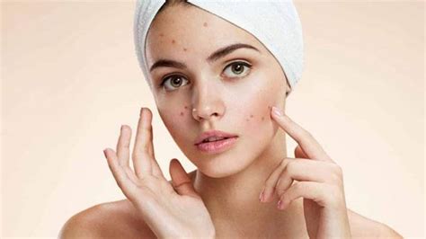 Preventive Measures to Keep Large Pimples at Bay