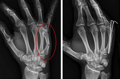 Psychological Factors Influencing Dreams of Finger Fracture