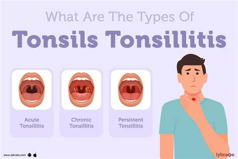 Recognizing the Indications of Affected Tonsils