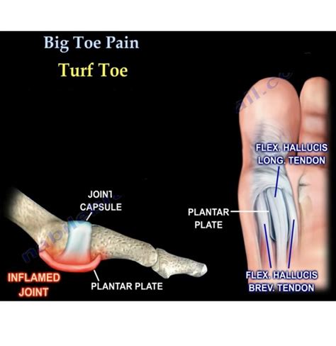 Recognizing the Symptoms of Great Toe Discomfort