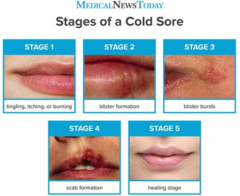 Recognizing the Symptoms of a Cold Sore Episode